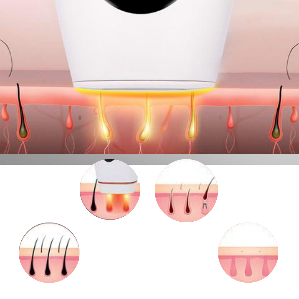 Laser IPL per la rimozione dei peli portatile